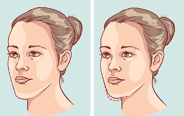 Nhổ răng khôn có làm thay đổi cấu trúc khuôn mặt không? 2 Nhổ răng khôn