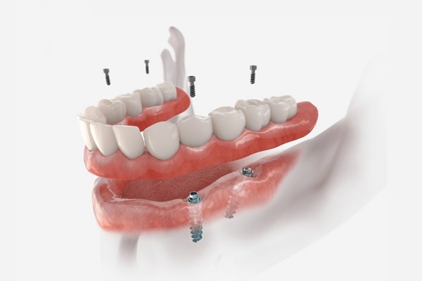 Trồng răng Implant có thật sự tốt không?