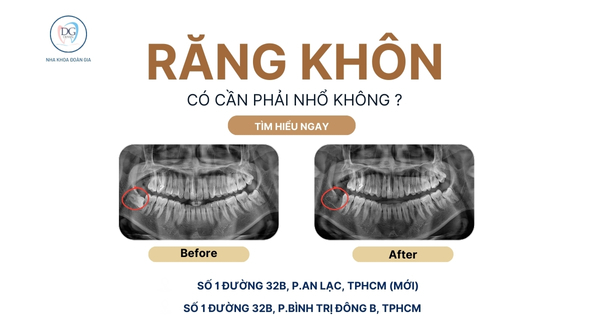 1. CÓ PHẢI RĂNG KHÔN LÚC NÀO CŨNG PHẢI NHỔ KHÔNG