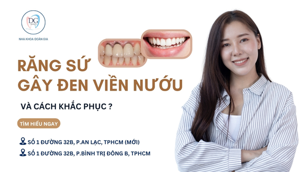 11. VÌ SAO RĂNG SỨ KIM LOẠI GÂY ĐEN VIỀN NƯỚU VÀ CÁCH KHẮC PHỤC