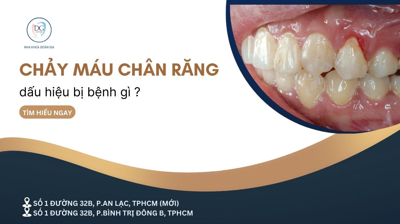 13. CHẢY MÁU CHÂN RĂNG  DẤU HIỆU CỦA BỆNH GÌ