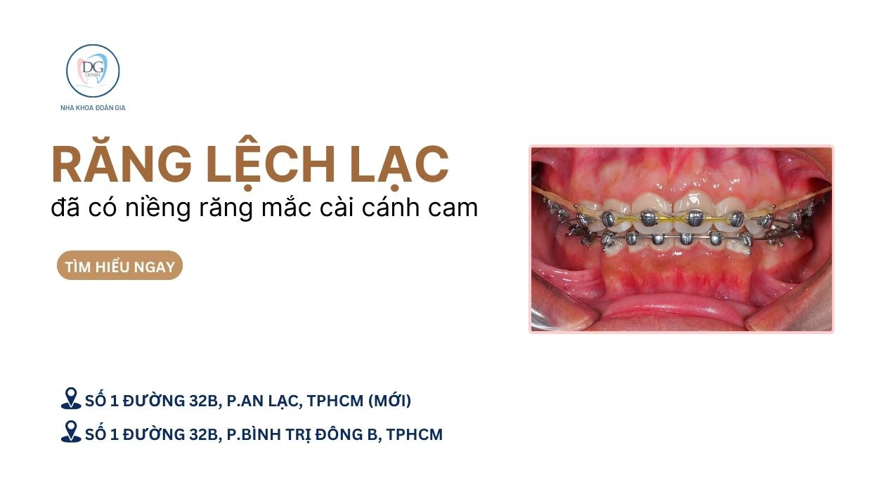 13. NIỀNG MẮC CÀI CÁNH CAM  GIẢI PHÁP HOÀN HẢO CHO RĂNG LỆCH LẠC