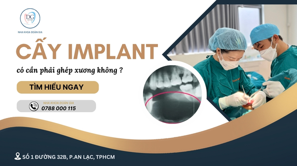 17. CẤY IMPLANT CÓ CẦN PHẢI GHÉP XƯƠNG KHÔNG