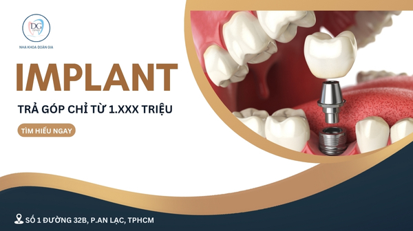 22. IMPLANT TRẢ GÓP CHỈ TỪ 1XXX TRIỆU