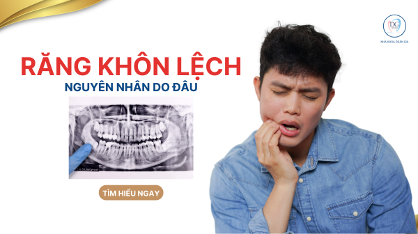 22. VÌ SAO RĂNG KHÔN DỄ MỌC LỆCH  NGUYÊN NHÂN VÀ HƯỚNG XỬ LÝ