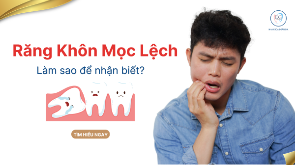 23. RĂNG KHÔN MỌC LỆCH LÀM SAO ĐỂ NHẬN BIẾT