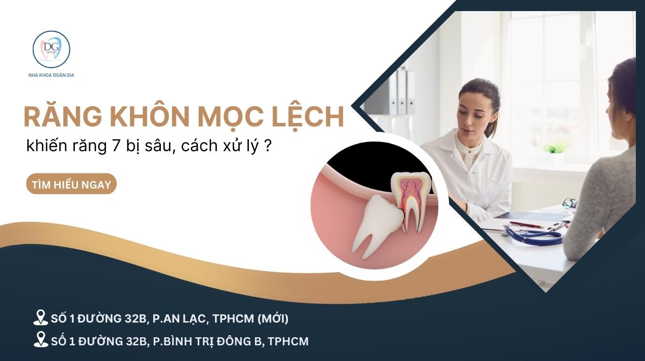 25. RĂNG KHÔN MỌC LỆCH KHIẾN RĂNG SỐ 7 BỊ SÂU  CÁCH XỬ LÝ TRIỆT ĐỂ