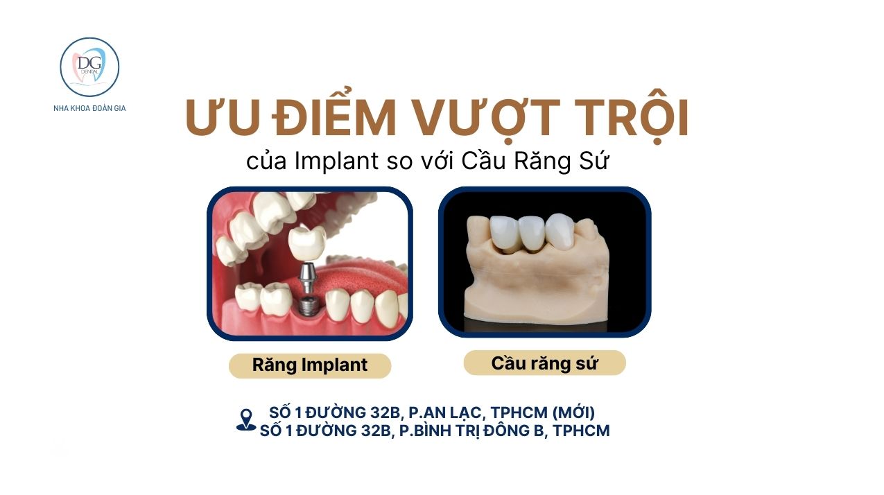 26. ƯU ĐIỂM VƯỢT TRỘI CỦA IMPLANT SO VỚI CẦU RĂNG SỨ