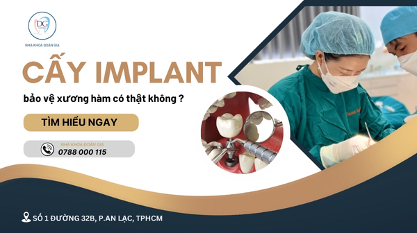 28. VÌ SAO CẤY IMPLANT BẢO VỆ XƯƠNG HÀM