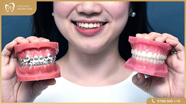 Niềng răng là phương pháp gì?