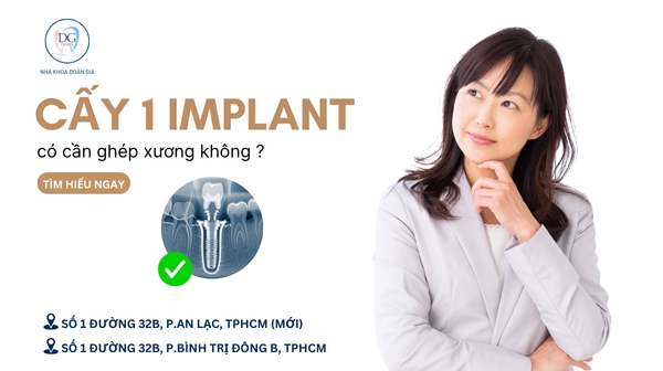 30. CẤY IMPLANT 1 RĂNG CÓ CẦN GHÉP XƯƠNG KHÔNG