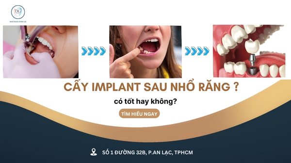 30. CẤY IMPLANT SAU KHI NHỔ RĂNG