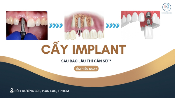 33. CẤY IMPLANT SAU BAO LÂU THÌ GẮN SỨ