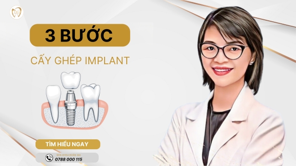 3 BƯỚC CẤY GHÉP IMPLANT