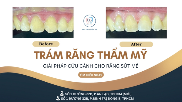 53. TRÁM RĂNG THẨM MỸ  GIẢI PHÁP CỨU CÁNH CHO RĂNG SỨT MẺ