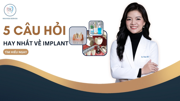 5 CÂU HỎI HAY NHẤT VỀ IMPLANT