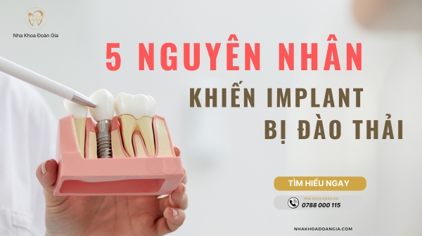 5 NGUYÊN NHÂN TRỤ IMPLANT BỊ ĐÀO THẢI