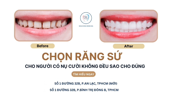7. RĂNG SỨ CHO NGƯỜI CÓ NỤ CƯỜI KHÔNG ĐỀU  LÀM SAO CHỌN ĐÚNG DÁNG RĂNG