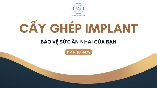 IMPLANT BẢO VỆ SỨC ĂN NHAI CỦA BẠN