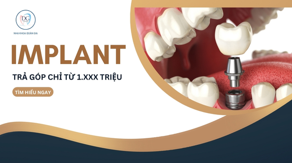 IMPLANT TRẢ GÓP CHỈ TỪ 1XXX TRIỆU