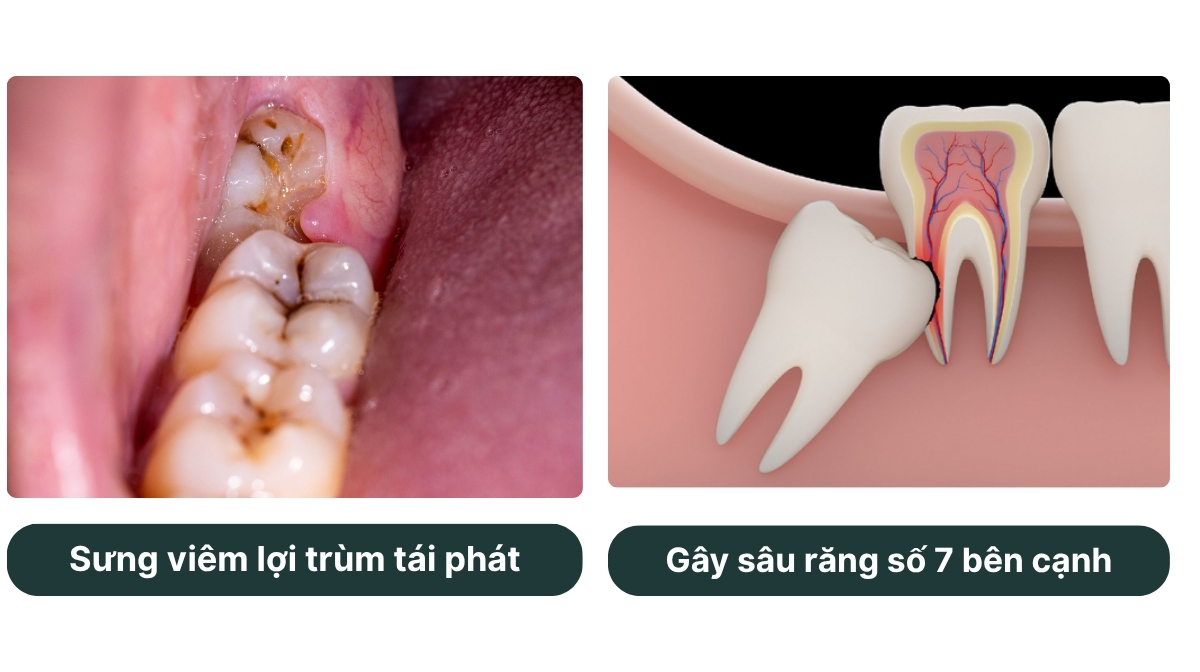 KHI NÀO NÊN NHỔ RĂNG KHÔN 2