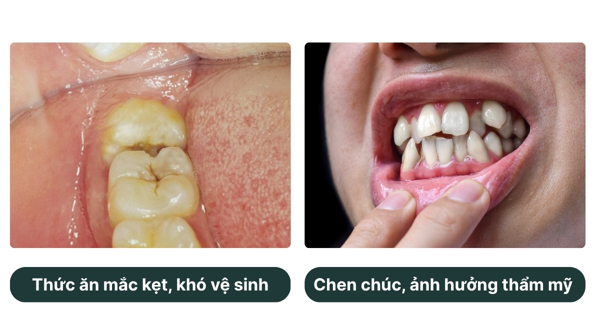 KHI NÀO NÊN NHỔ RĂNG KHÔN 3 1
