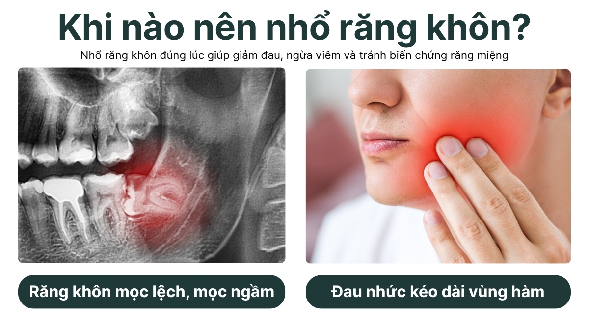 KHI NÀO NÊN NHỔ RĂNG KHÔN  1