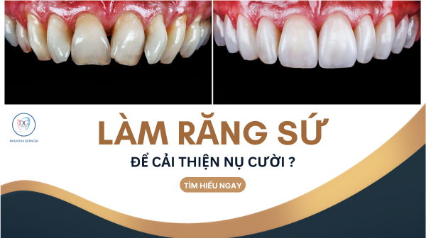 LÀM RĂNG SỨ CẢI THIỆN NỤ CƯỜI