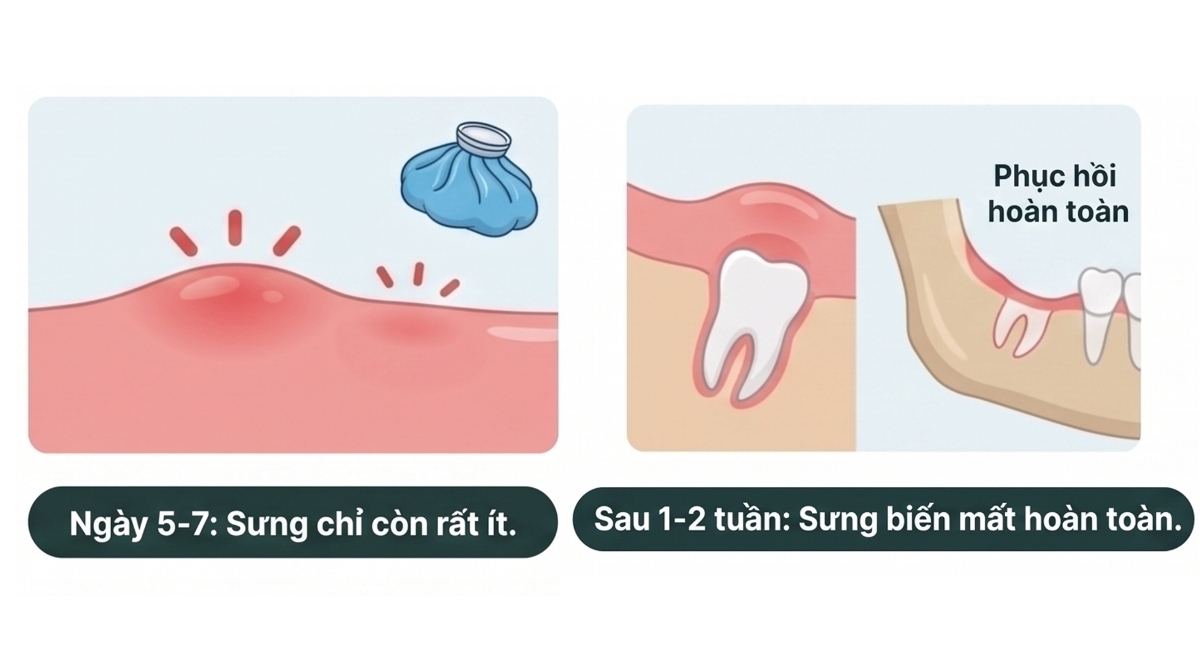 NHỔ RĂNG KHÔN BÀI 2
