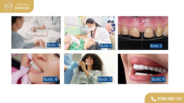 QUY TRÌNH BỌC RĂNG SỨ THẨM MỸ 1