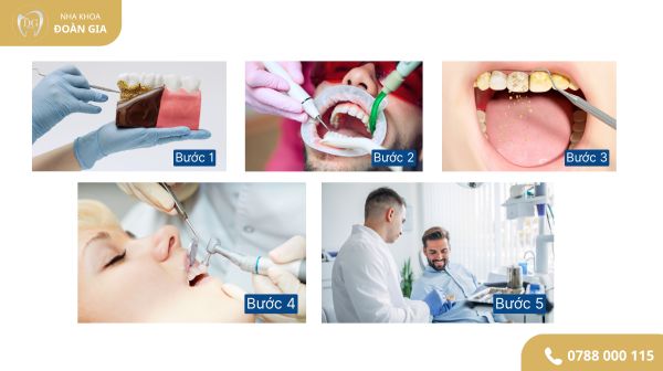 QUY TRÌNH CẠO VÔI RĂNG VÀ ĐÁNH BÓNG 1