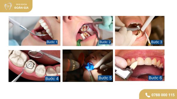 QUY TRÌNH ĐIỀU TRỊ TRÁM RĂNG SÂU 1