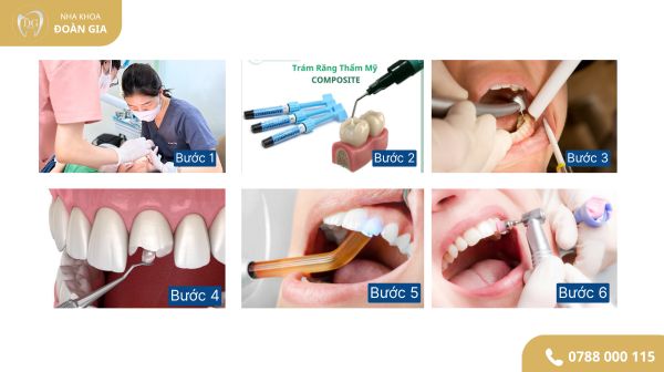 QUY TRÌNH ĐIỀU TRỊ TRÁM RĂNG THẨM MỸ 1