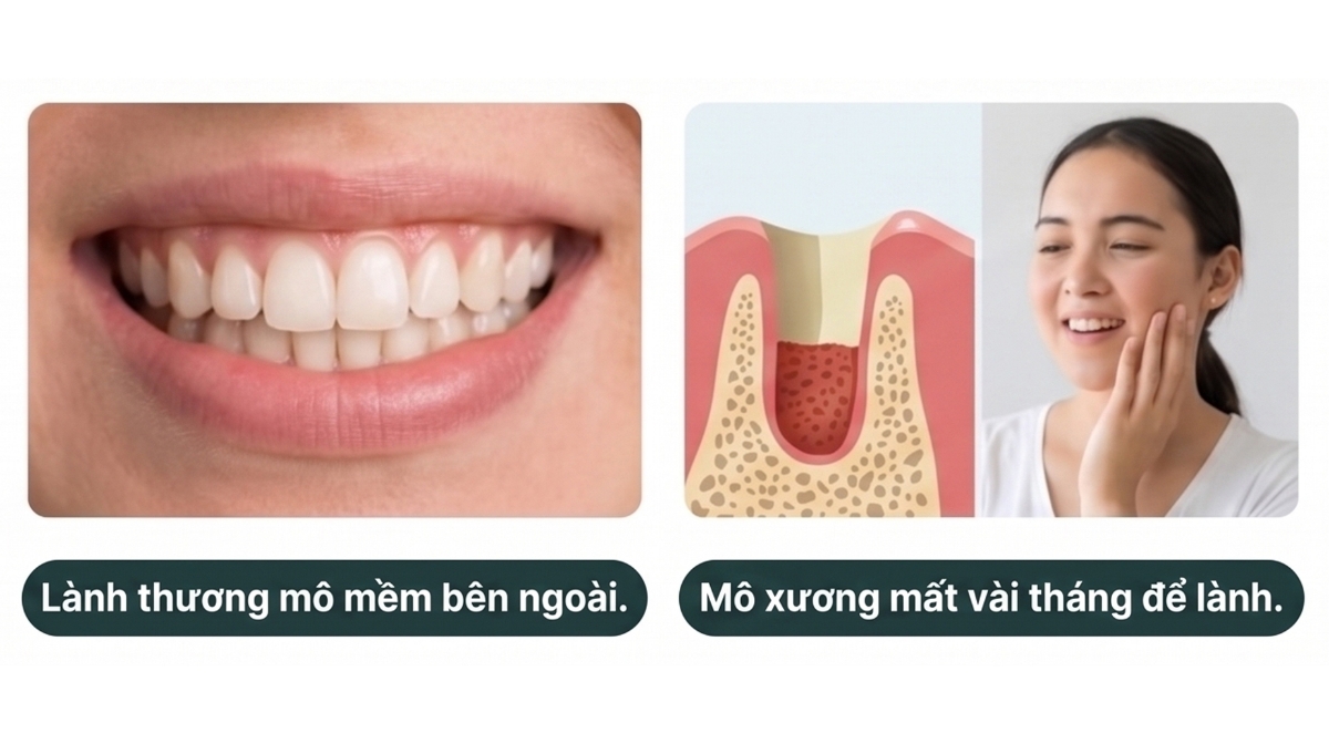 SAU NHỔ RĂNG KHÔN BAO LÂU HẾT SƯNG 3