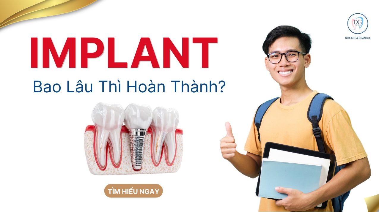 TRỒNG IMPLANT BAO LÂU HOÀN THÀNH