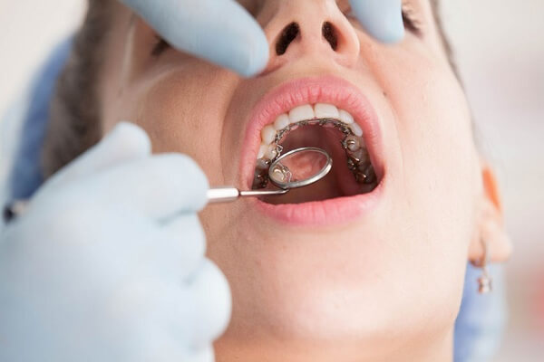 Niềng răng mắc cài mặt trong khắc phục răng móm?