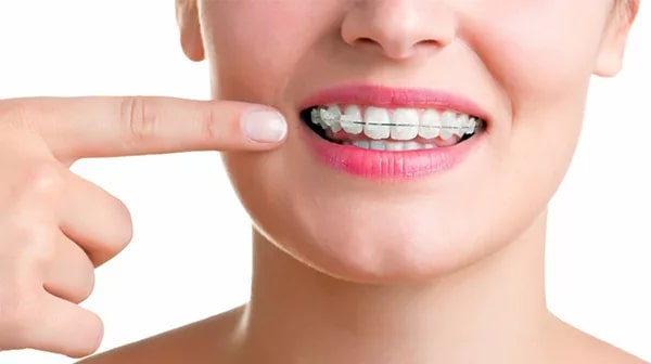 Người bị móm có nên niềng răng niềng răng mắc cài sứ?