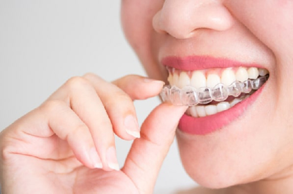 Các giai đoạn niềng răng và chỉnh nha phổ biến