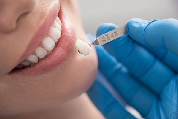 Quy trình bọc răng sứ cho răng mọc lệch tại Nha khoa Đoàn Gia