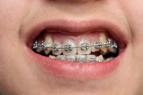 Giai đoạn xấu nhất khi niềng răng là giai đoạn nào?