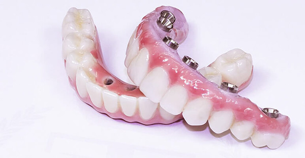 Răng giả tháo lắp trên trụ implant