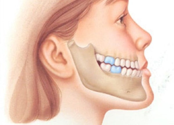 Răng như thế nào là bị hô?