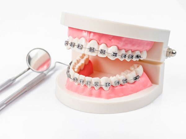 Răng bị hô hàm có niềng răng được không?
