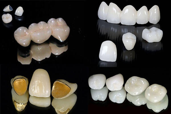 Răng sứ Emax là gì?