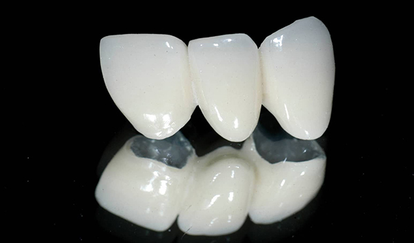 Răng toàn sứ Emax CAD
