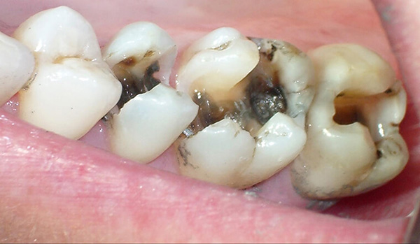 Những điều mà bạn nên biết về nhổ răng hay tiểu phẫu răng