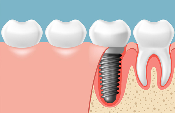 Vì sao nên chọn giải pháp trồng răng Implant 1 răng?