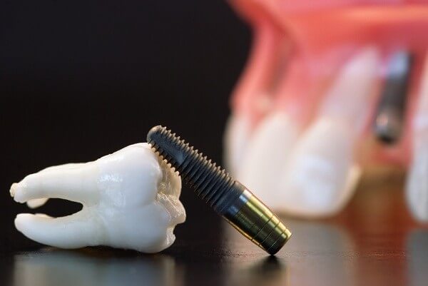 Nguyên nhân răng Implant lung lay