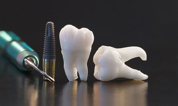 Cách khắc phục tình trạng răng Implant bị lung lay