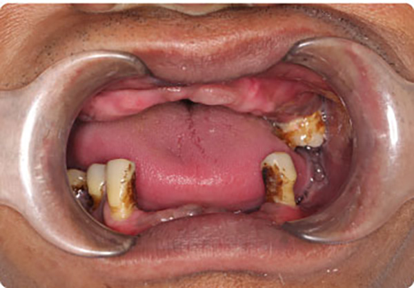 Người bị mất nhiều răng trên hàm